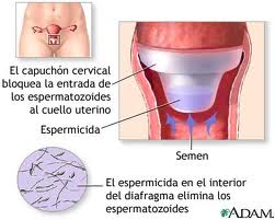 capuchon cervical.jpg